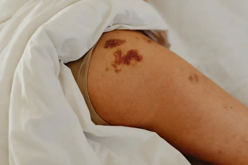 Photo d'une jambe de femme ayant une ecchymose à cause du lipoedème